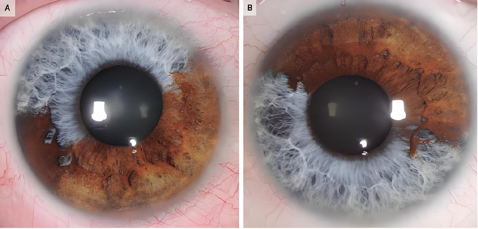 Side by side comparison of right and left eye iridology charts