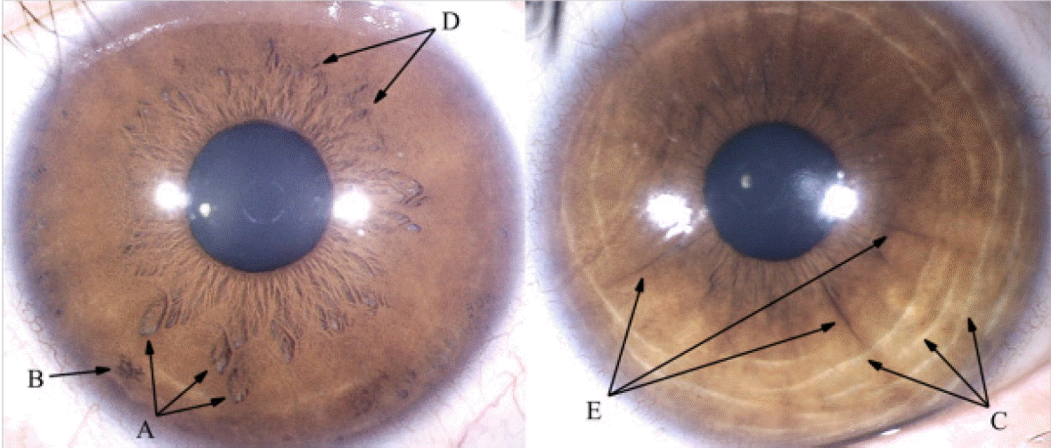 Side by side comparison of right and left eye iridology charts