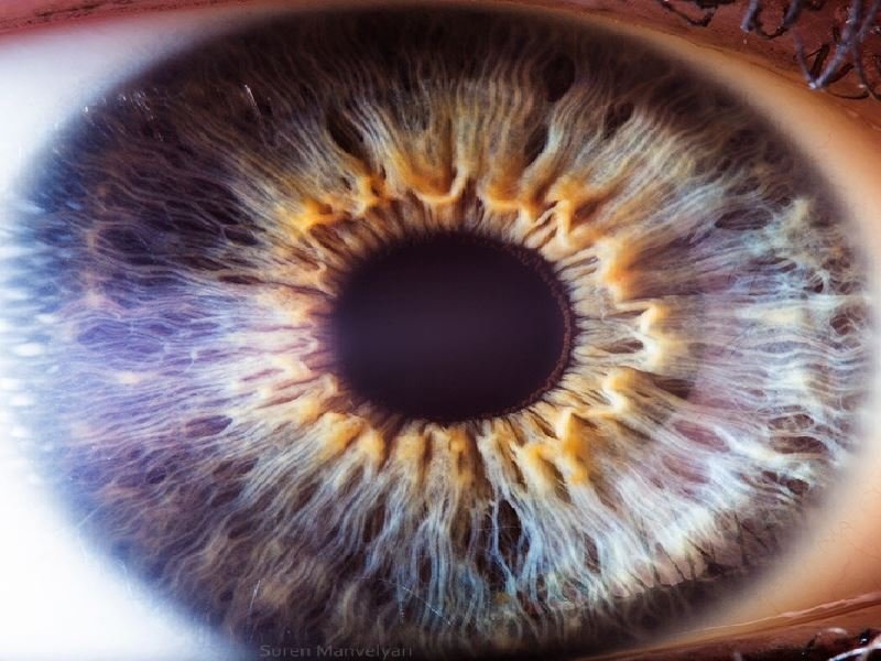 Radial furrows extending through iris tissue