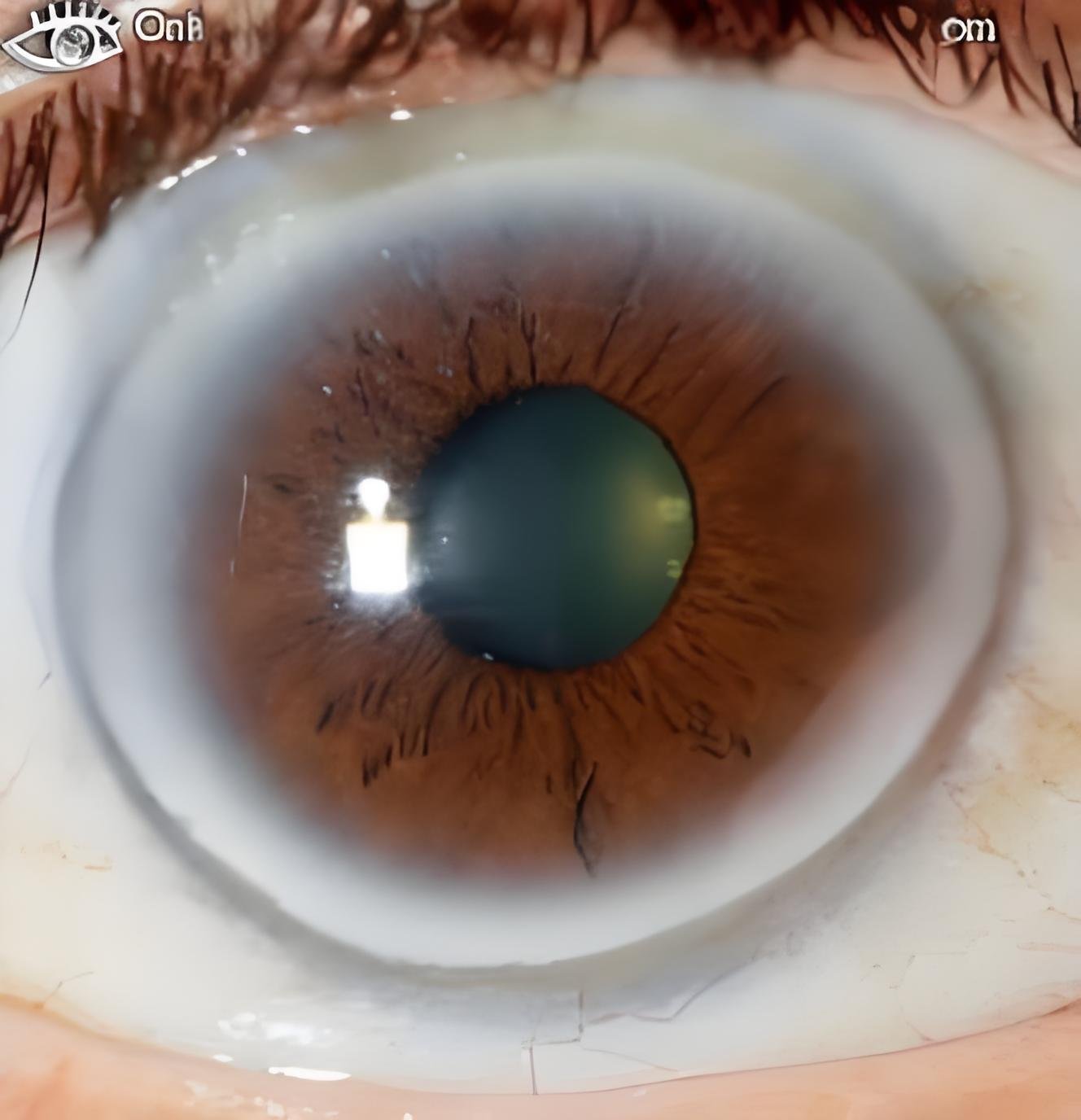 Close-up view of iris zones corresponding to lymphatic system areas on iridology chart