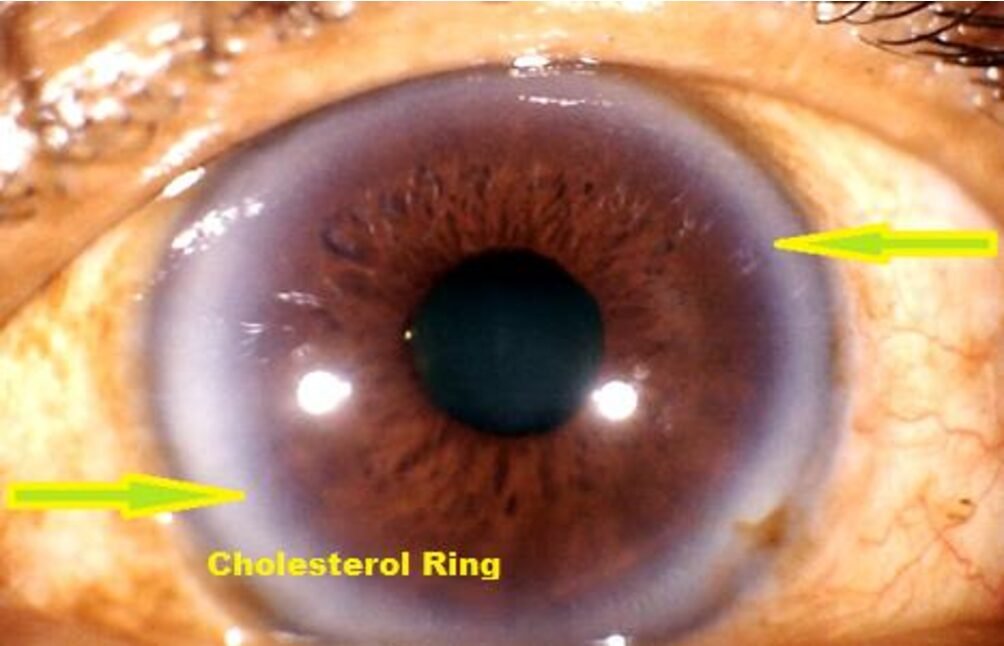 Side by side comparison of right and left eye iridology charts