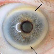 Side by side comparison of right and left eye iridology charts