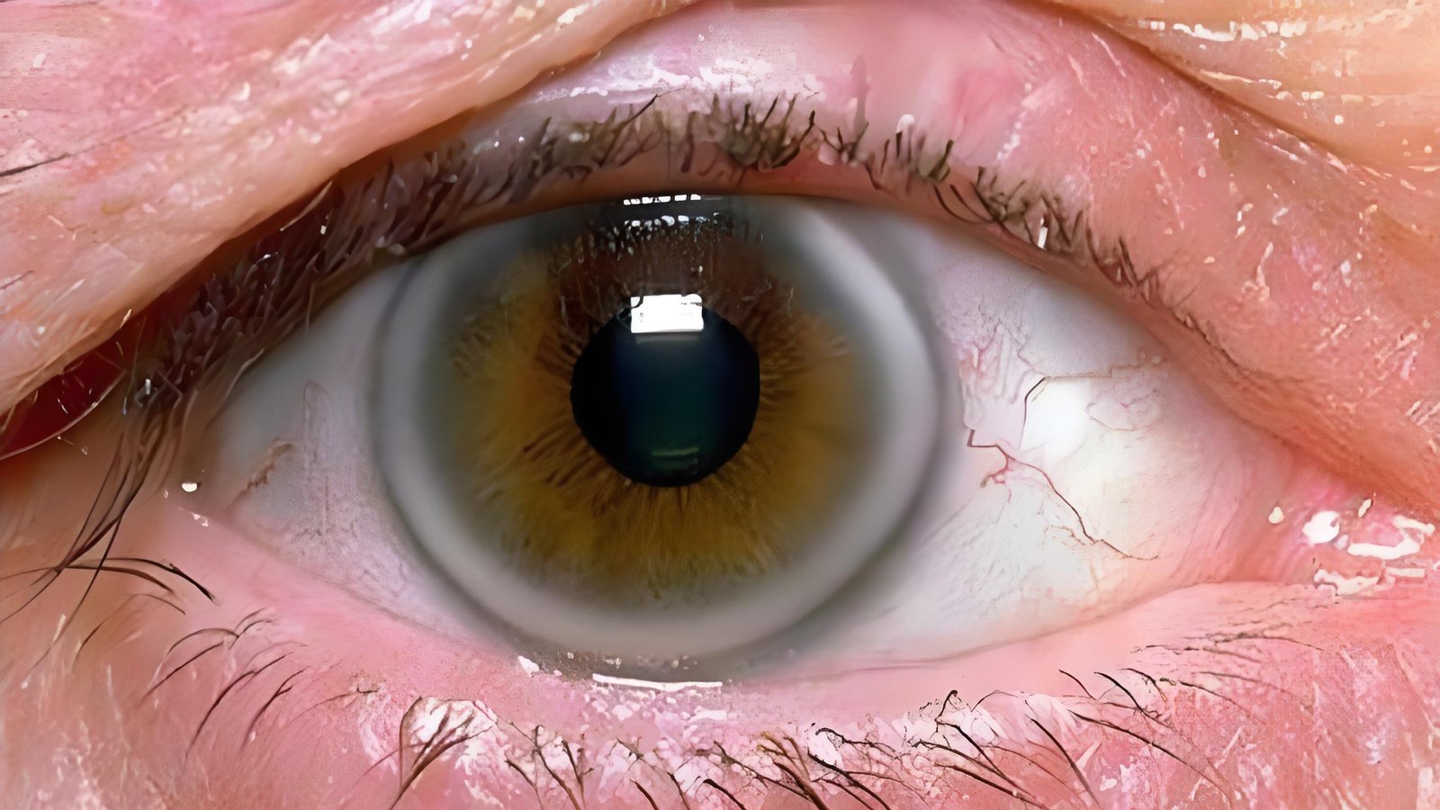 Professional iridology lymphatic chart showing detailed zone mapping of both eyes with organ correlations