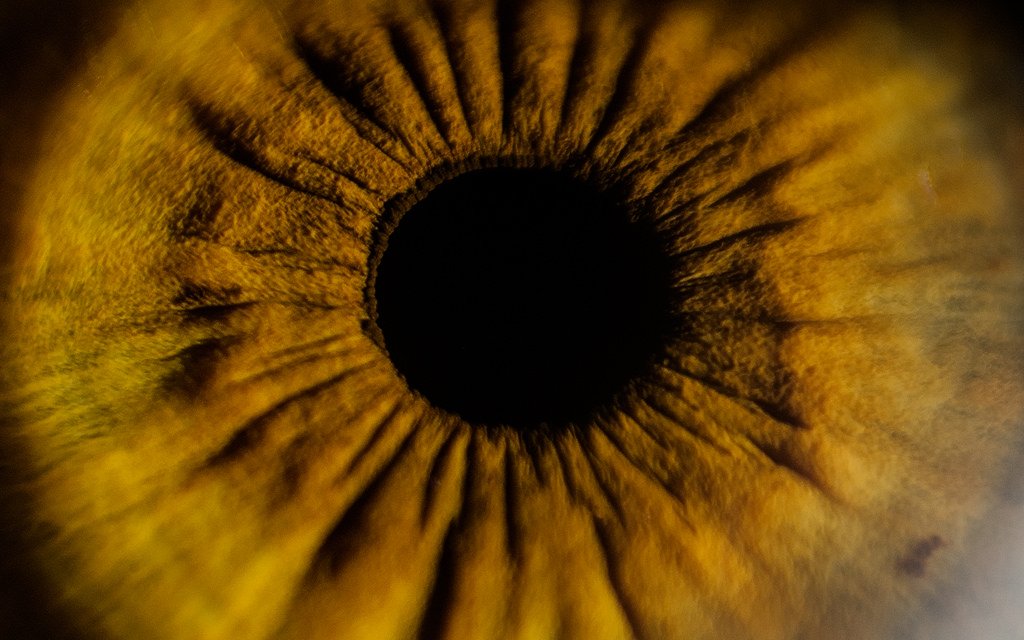 Radial furrows extending through iris tissue