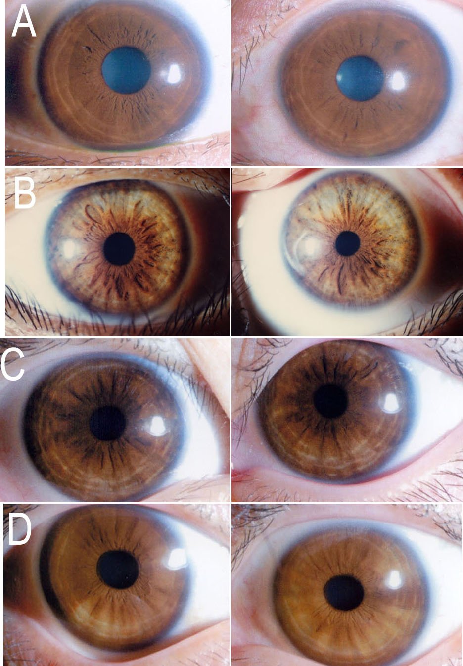 Radial furrows extending through iris tissue
