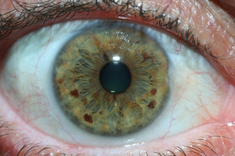 Detailed iris examination showing various iris patterns and structures