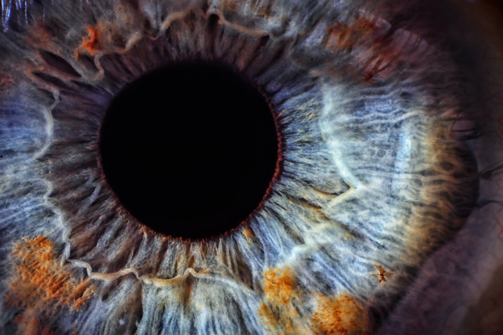 Comparison chart showing different megapixel resolutions in iridology camera iris images from 1.3MP to 12MP