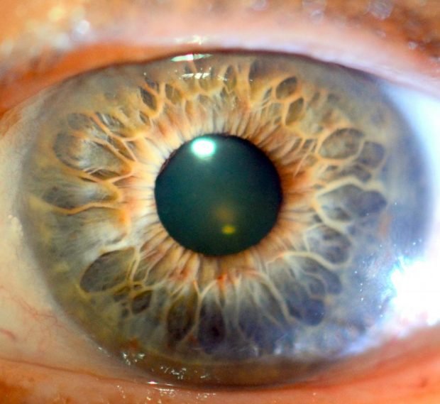 Iridology Case Studies of Lesions in Iris Closing: Understanding the Evidence, Boundaries, and Professional Practice Standards