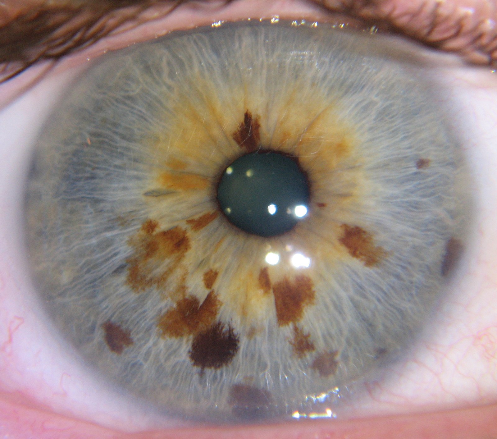 Split screen comparison showing basic versus advanced iridology software features and analysis capabilities