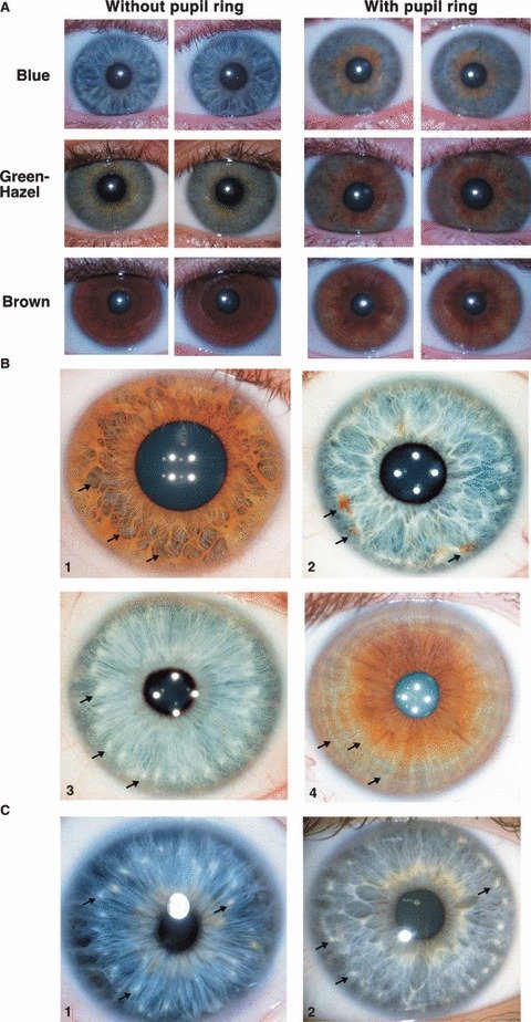 Comparison grid showing multiple iris examples with different patterns visible in kidney zone areas