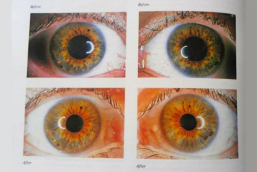 Side by side comparison of right and left eye iridology charts