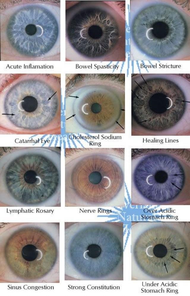 Three different iris colors showing constitutional variations