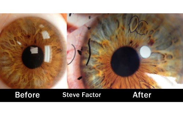 Before and after iris image enhancement comparison