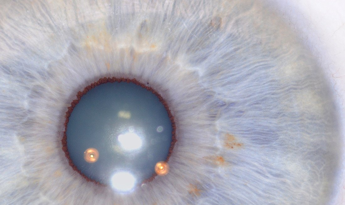 Close-up view of right iris with highlighted pancreas zone region showing anatomical position