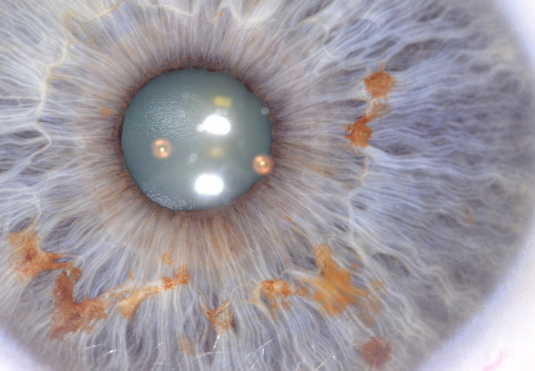 Resolution comparison showing iris detail at different megapixel levels