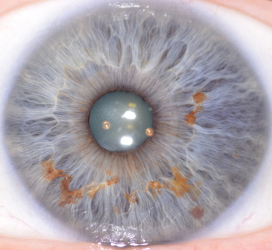 Resolution comparison showing iris detail at different megapixel levels