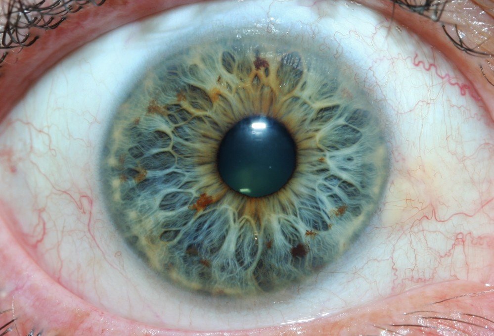 Professional iridology liver chart showing detailed iris zone mappings