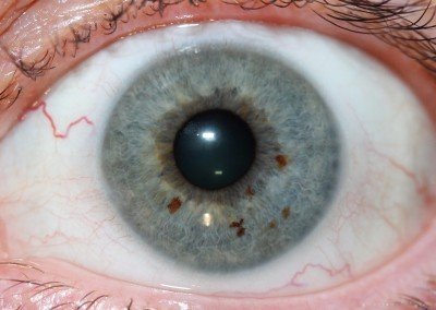 Professional iridology liver chart showing detailed iris zone mappings