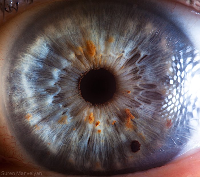 Comparison of iris images from high resolution vs low resolution iridology cameras