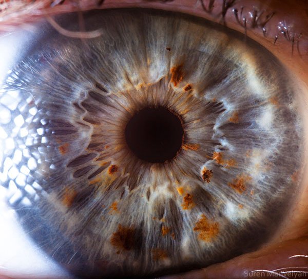 Comparison of iris images from high resolution vs low resolution iridology cameras
