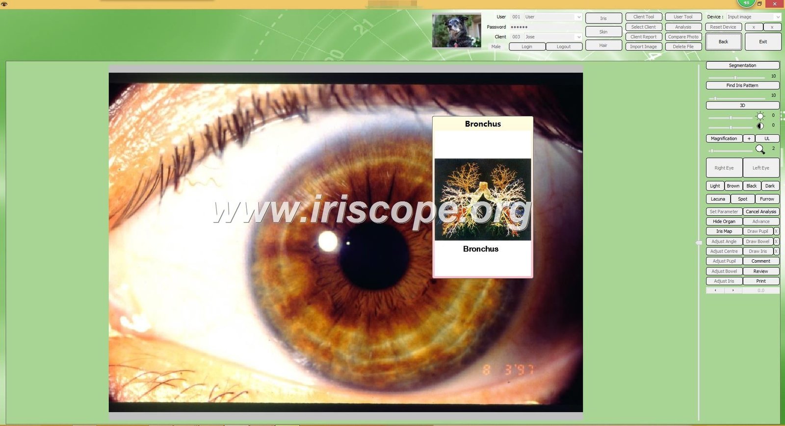 Professional iridology camera system with monitor displaying iris analysis software
