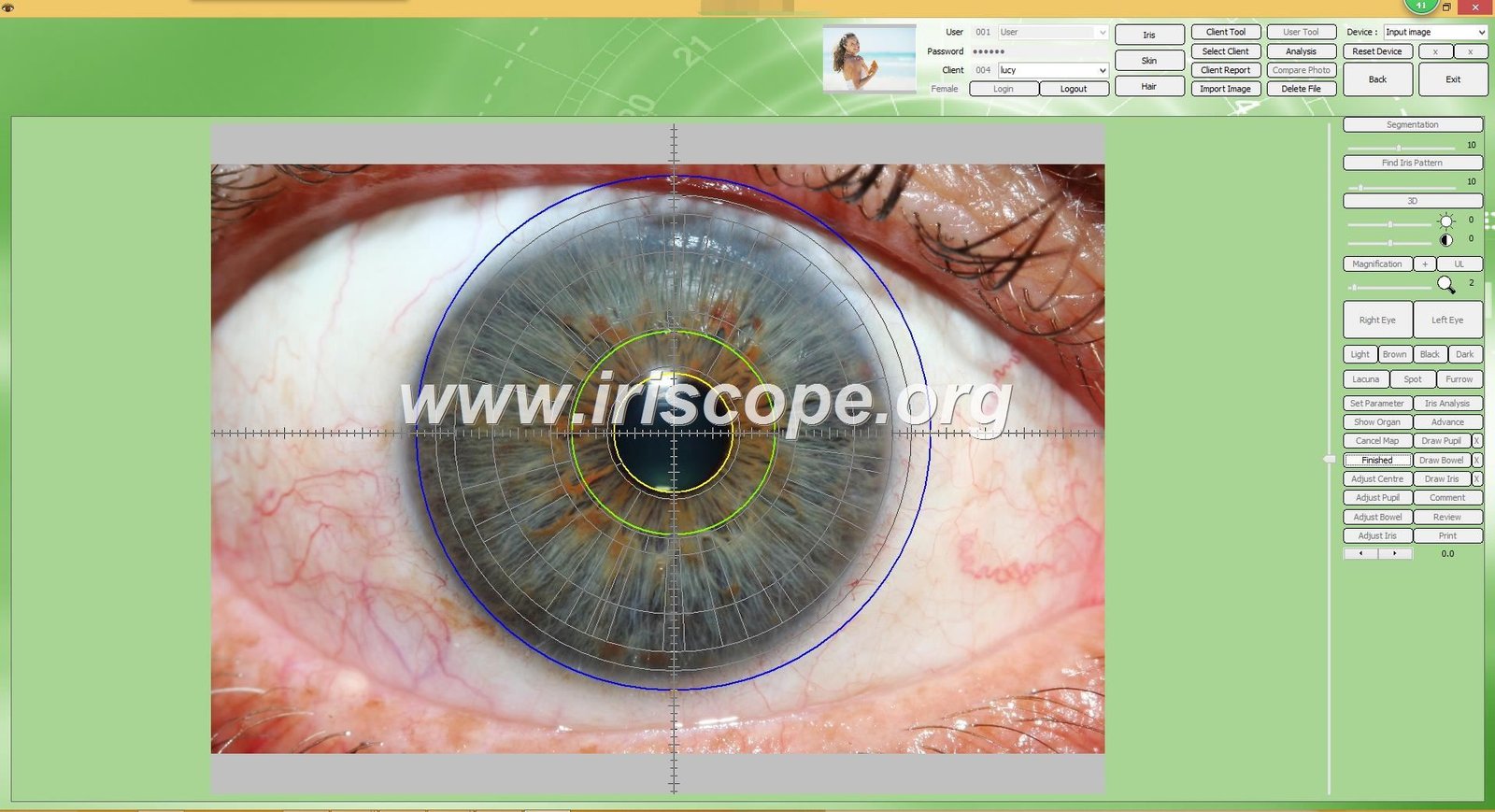 Automated iris analysis software identifying health markers