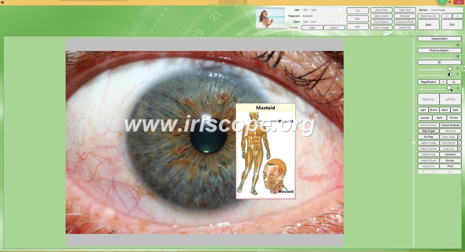 iridology software interface displaying iris analysis
