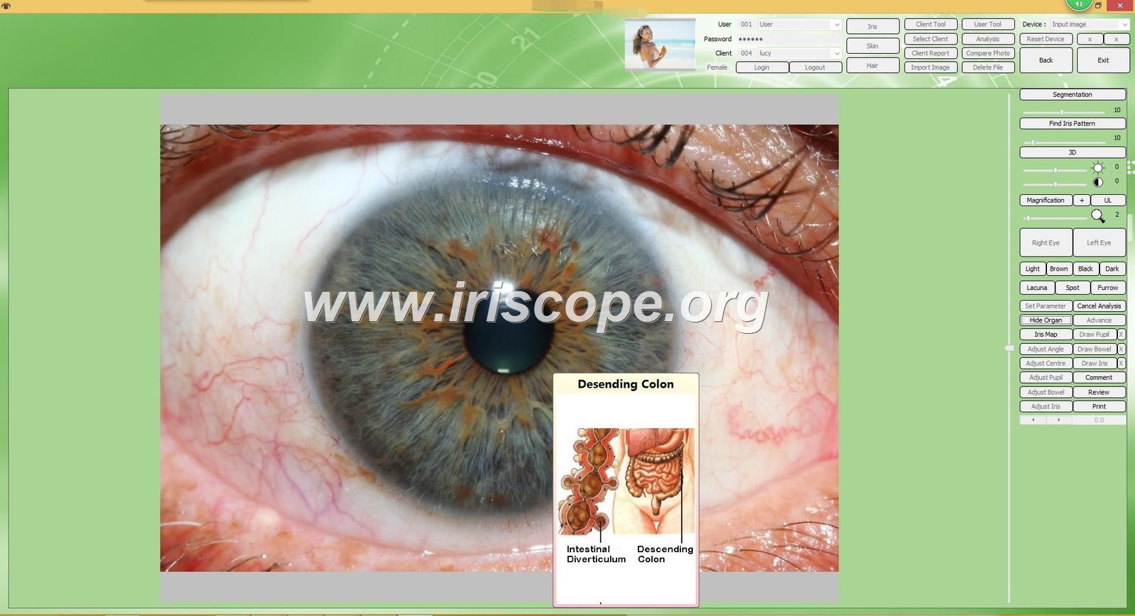 Iridology software interface showing multiple analysis tools and features
