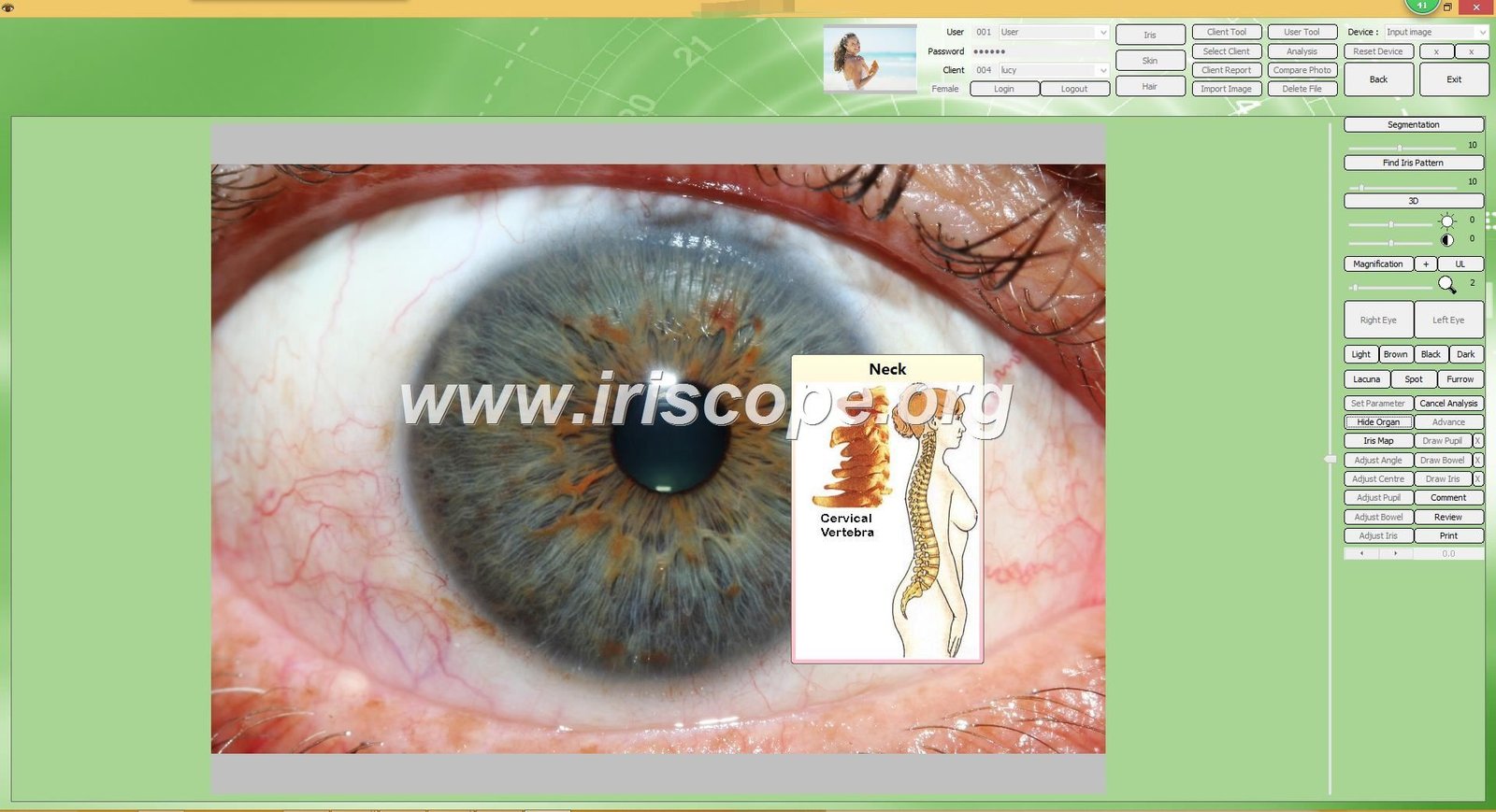 Iridology software interface showing multiple analysis tools and features
