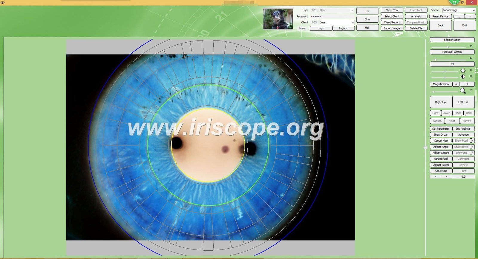 3D iridology analysis visualization from MAIKONG software