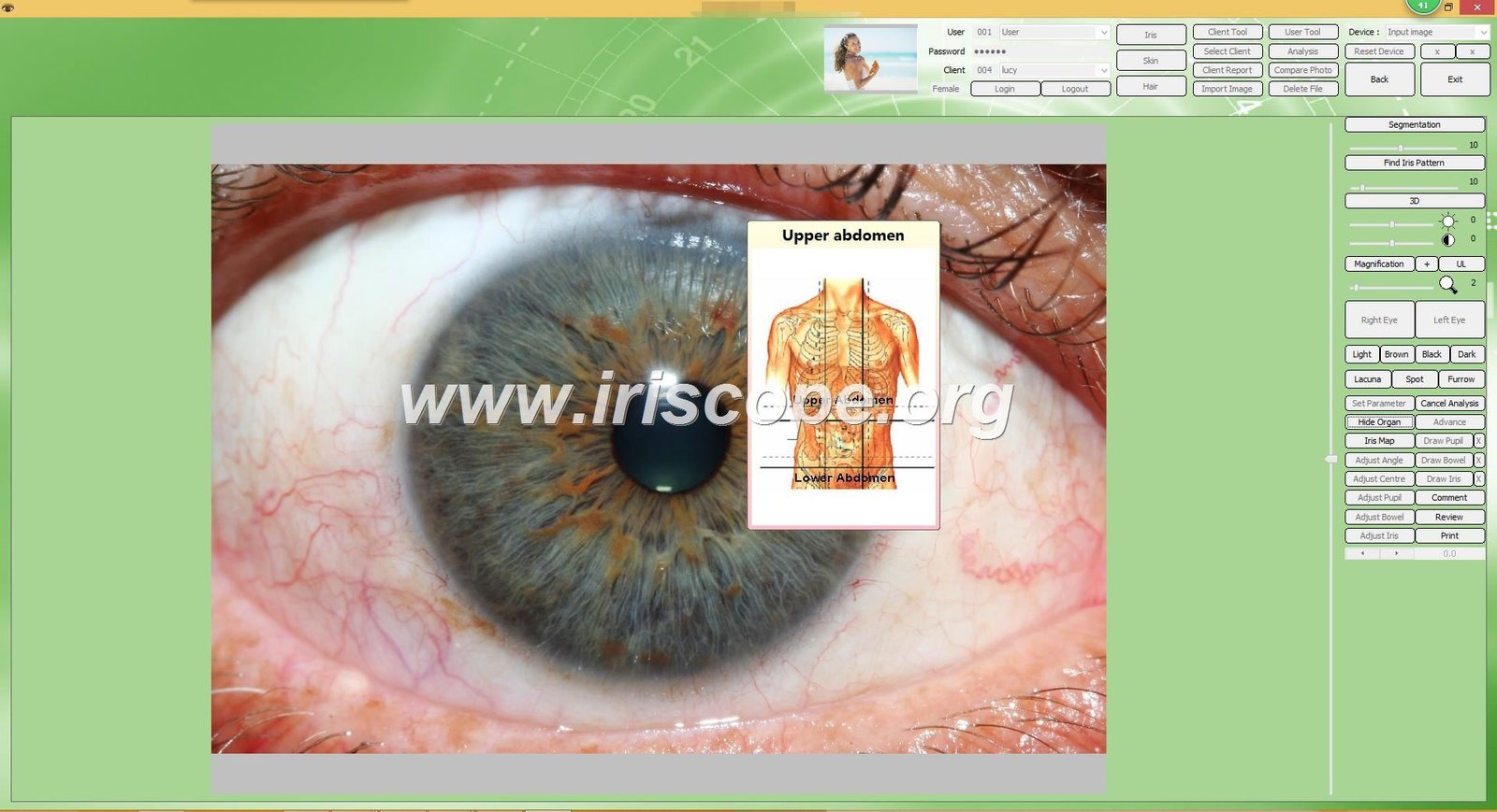 MAIKONG iridology software interface showing iris analysis with health indicators