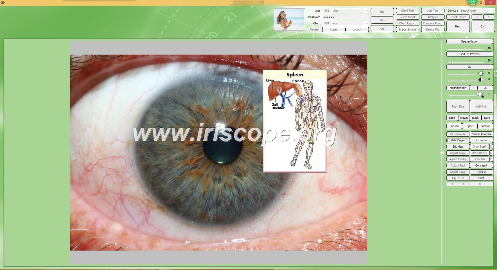 MAIKONG iridology software interface showing iris analysis with health indicators