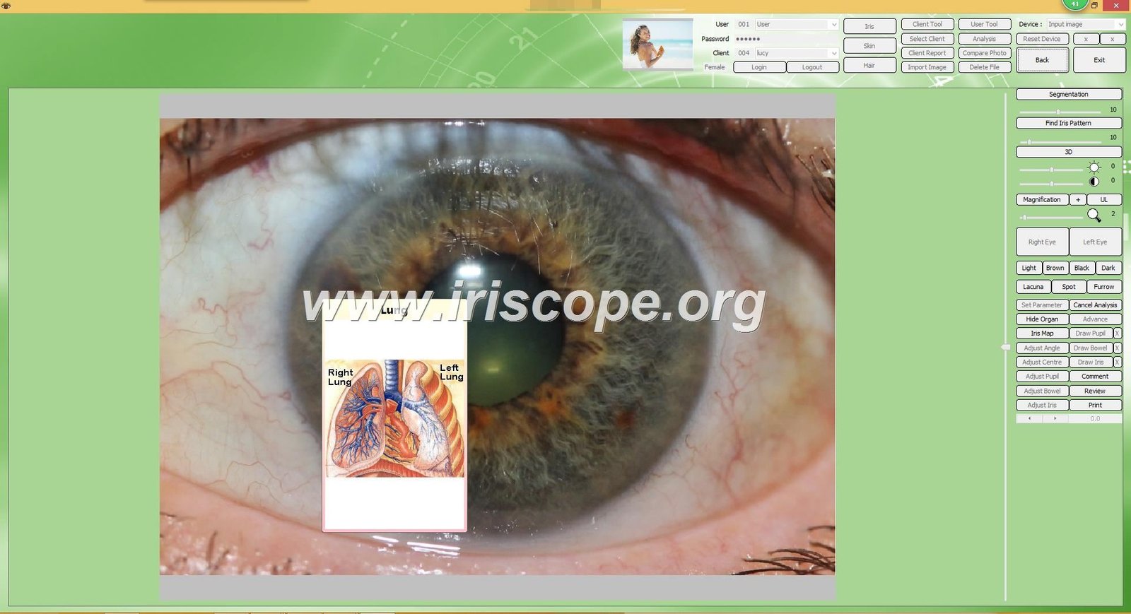 MAIKONG iridology software interface showing iris analysis on computer screen