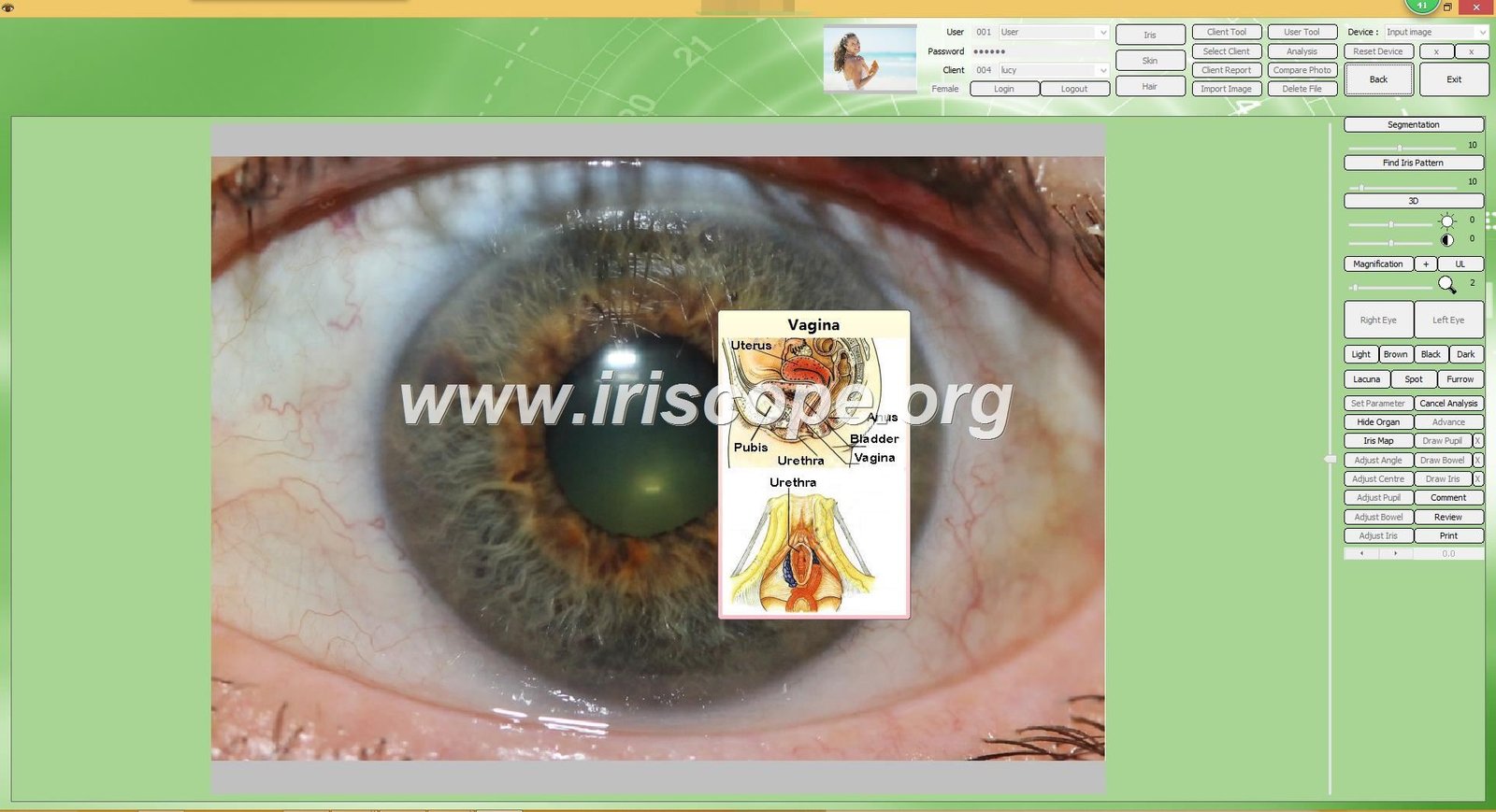 MAIKONG iridology software interface showing iris analysis on computer screen