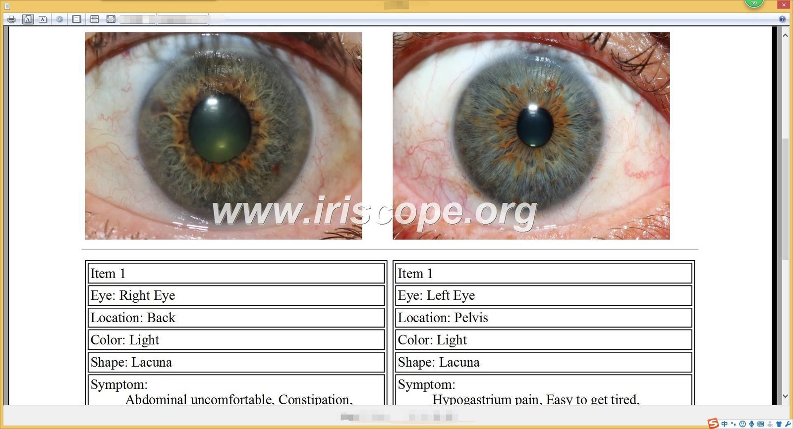 Iridology software interface showing iris analysis and health assessment tools