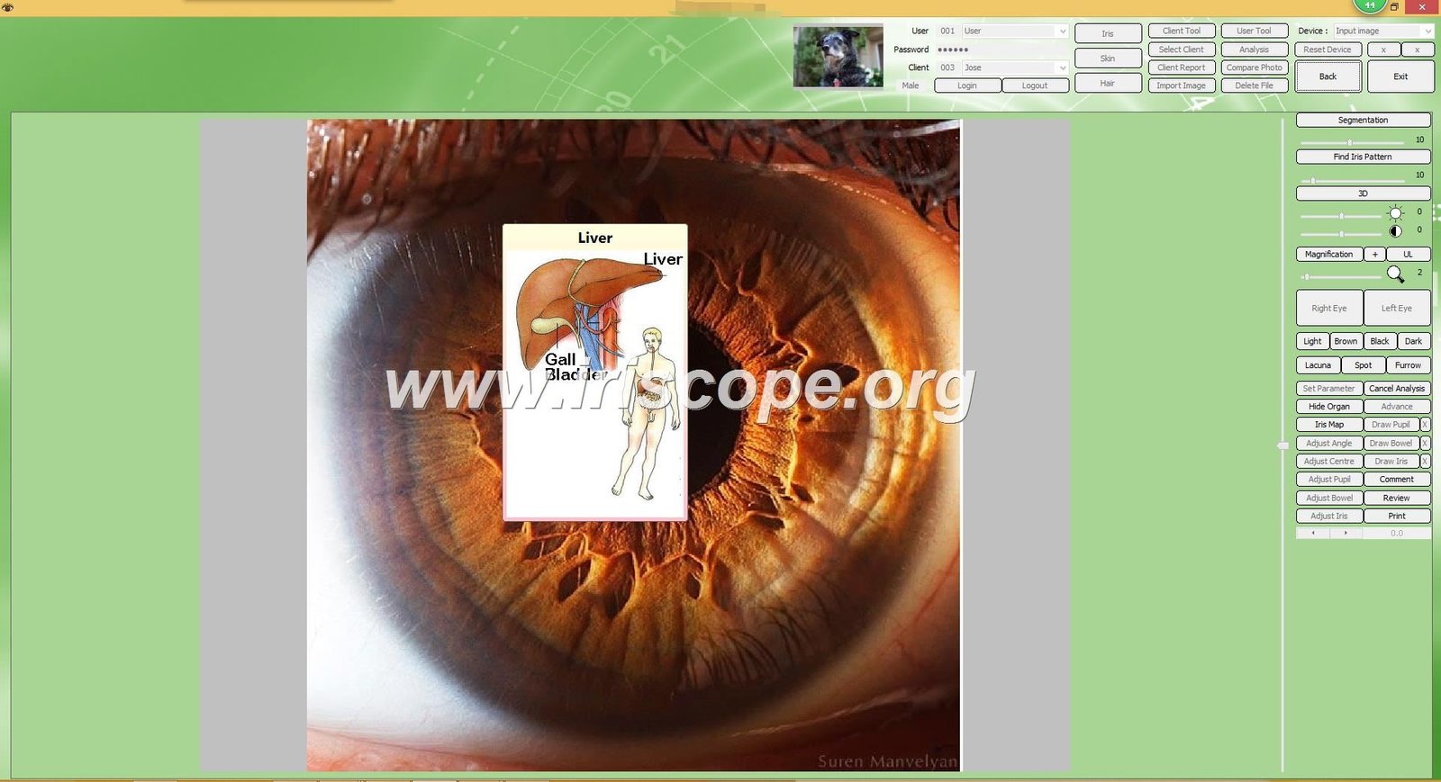 Computer screen showing iridology analysis software with kidney chart overlay on high-resolution iris photograph