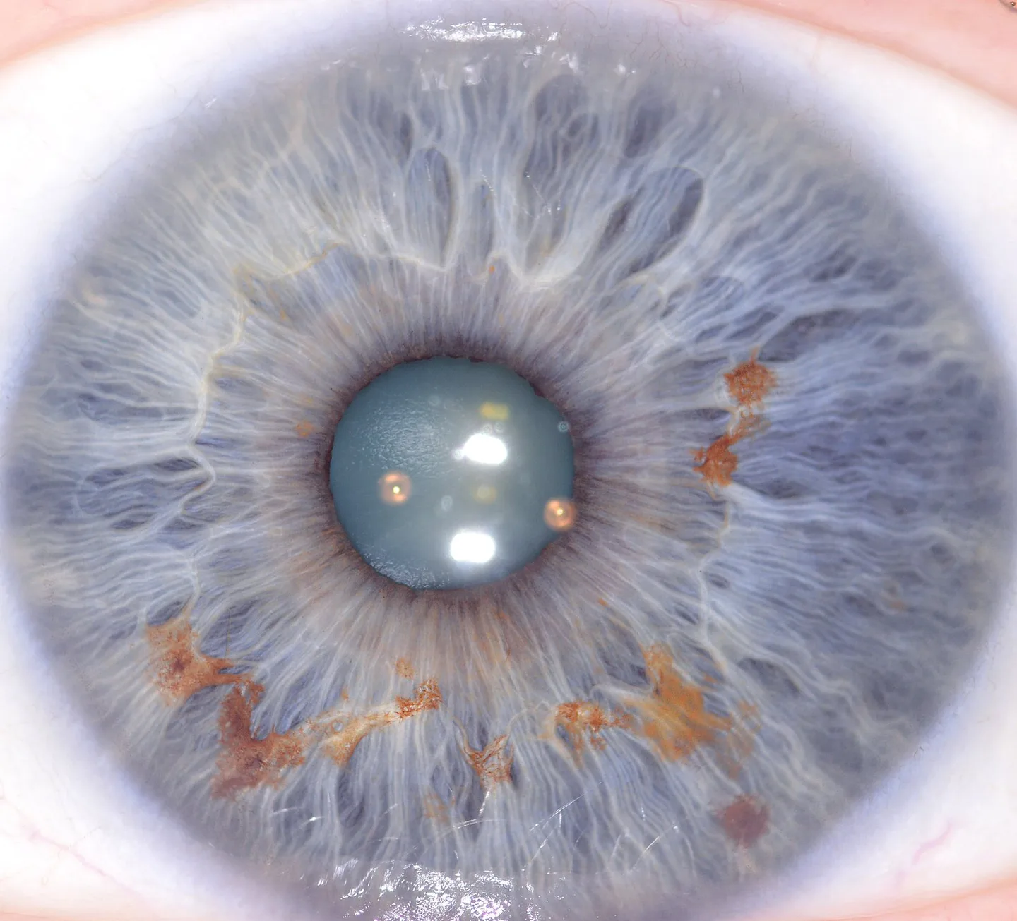 Iridology and Patterns on the Iris: A Practical Guide for Canadian Training Institutions — 002 (5).jpg
