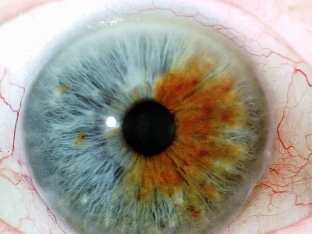 The Study of Iridology: A Practical Introduction to Sclerology for Holistic Health Centres in Canada — Iridología (3).jpg