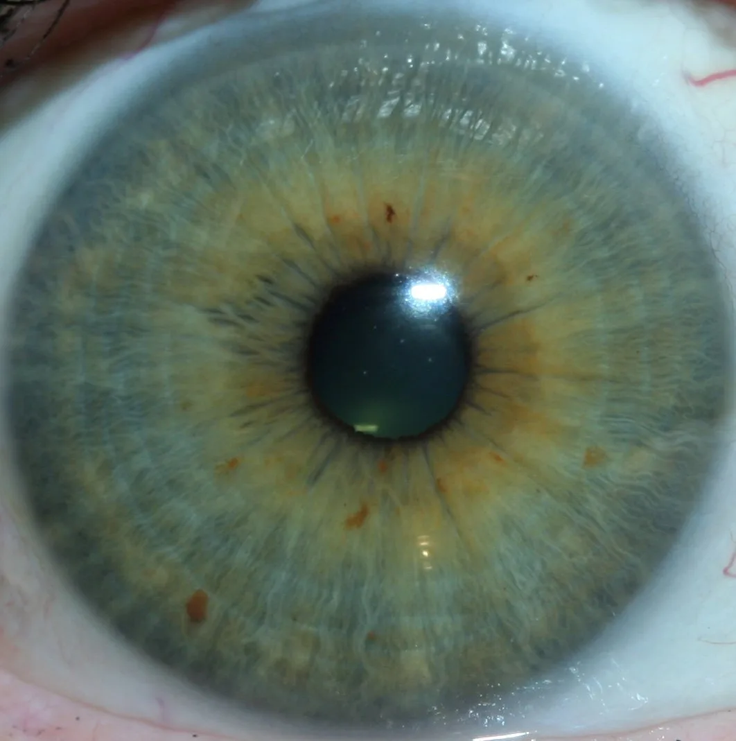 Controlling lighting and reflections for sharp iris photography in Canadian clinics — Portrait-of-Ignatz-von-Peczely-the-father-of-modern-iridology.jpeg
